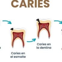 Información sobre caries